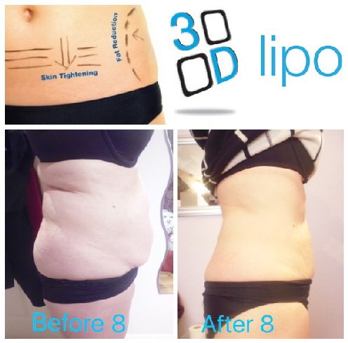 3D-Lipo at Maples Bridgend