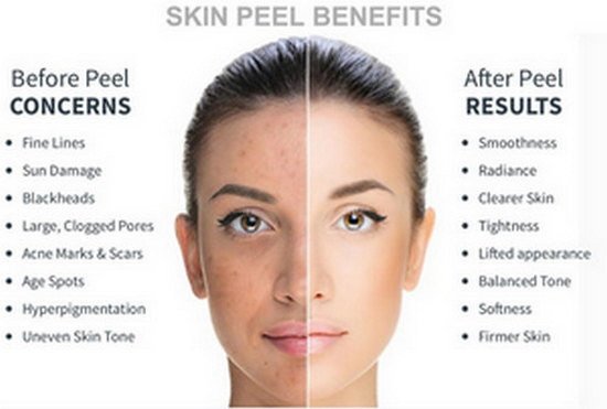 Skin Peel at Maples Bridgend